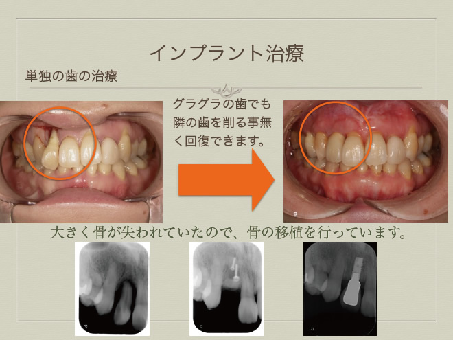 インプラント症例　単独の歯の治療1