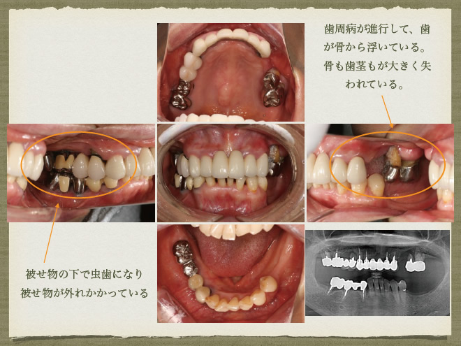 インプラントと義歯を使った治療　参考症例1