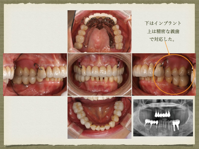 インプラントと義歯を使った治療　参考症例2